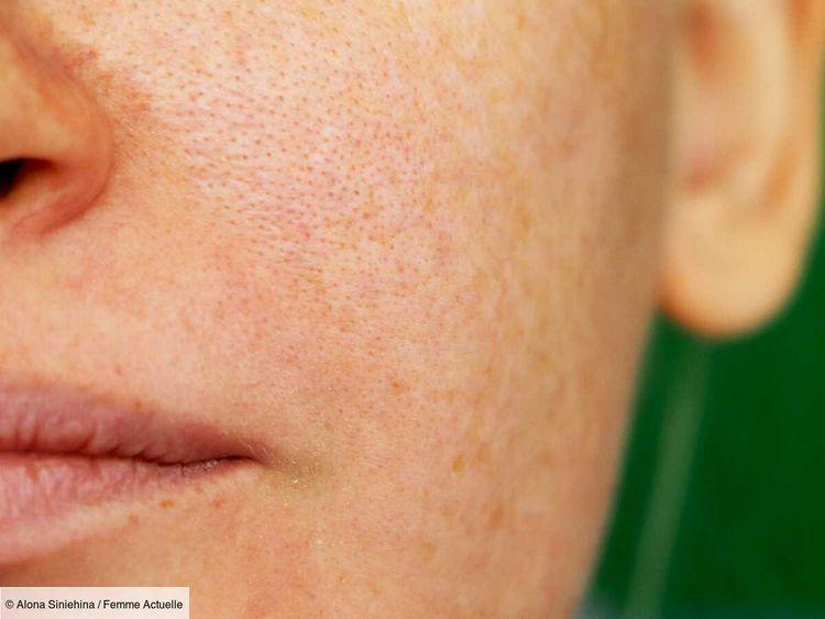 Comment atténuer l'apparence des pores dilatés et lisser le grain de peau ?