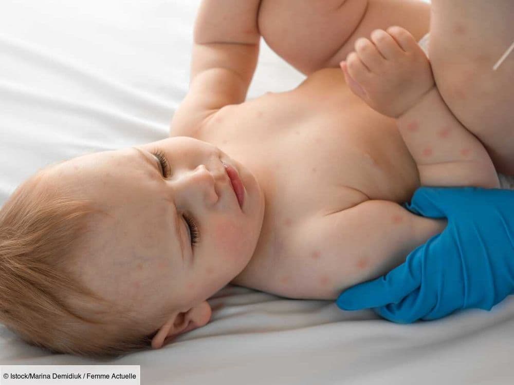 Varicelle chez le bébé : combien de temps dure cette maladie infectieuse ?