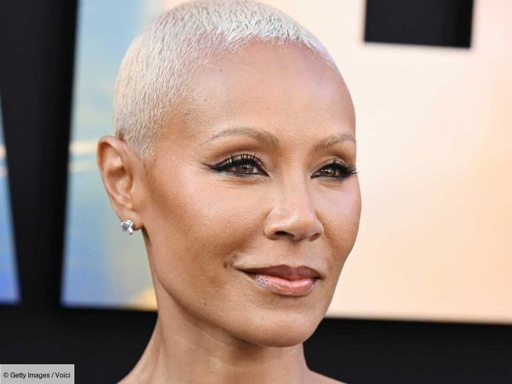 Greffe de cheveux chez la femme : tout ce qu’il faut savoir sur la méthode qui densifie la chevelure