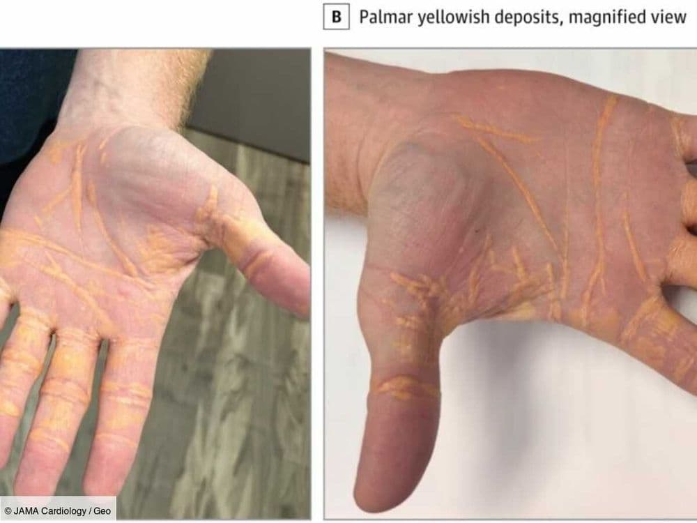 En Floride, un homme au régime exclusivement carnivore a vu sa peau se couvrir d'étranges traces jaunes