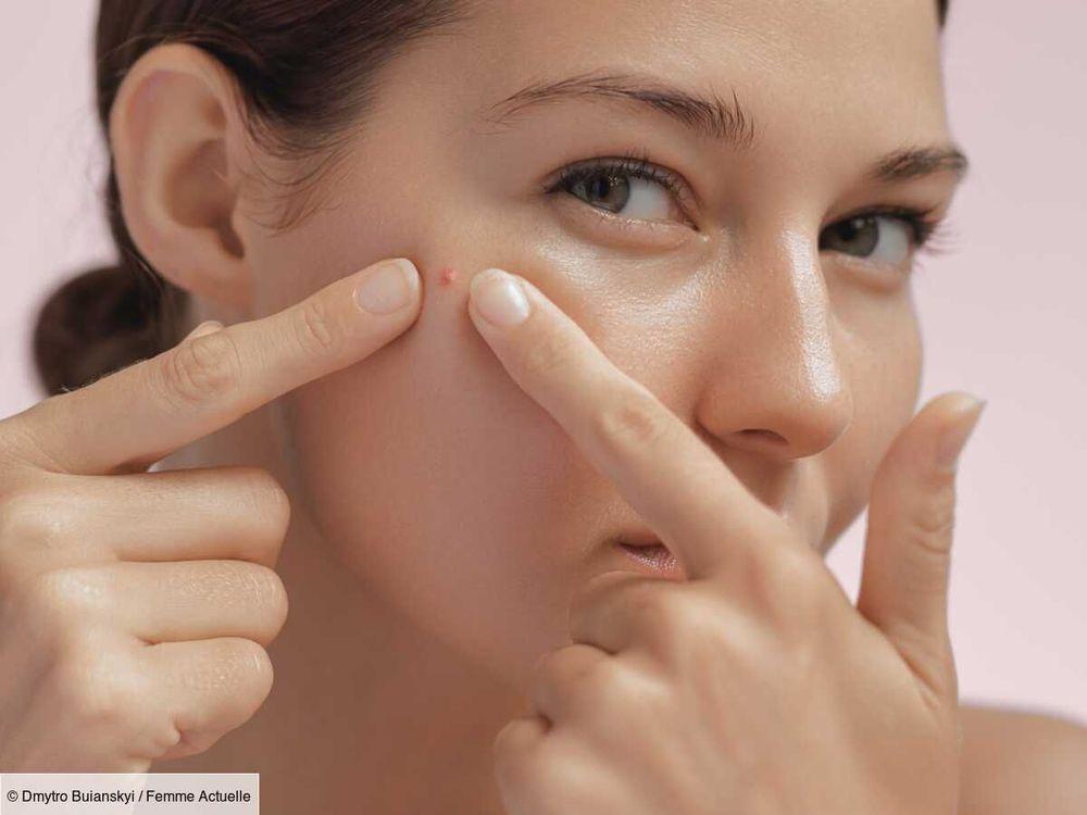 Percer un bouton sur le visage : bonne ou mauvaise idée ? La réponse d'une dermatologue