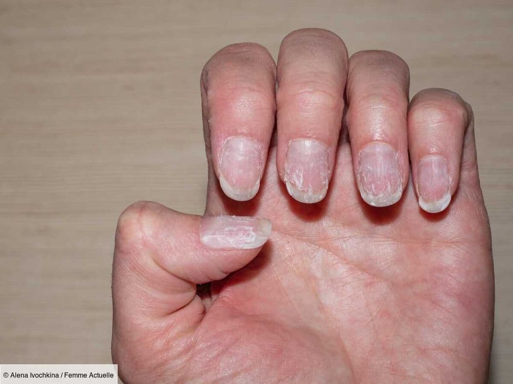 Ongles mous, abîmés, cassants : un dermatologue révèle une astuce étonnante et toute simple pour les réparer avec un produit de soin que l’on a tous chez soi
