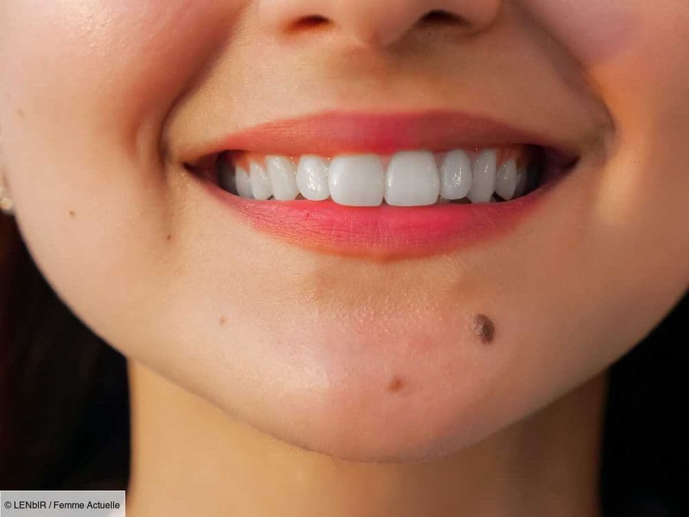 Peut-on épiler un poil sur un grain de beauté ? Un dermatologue répond