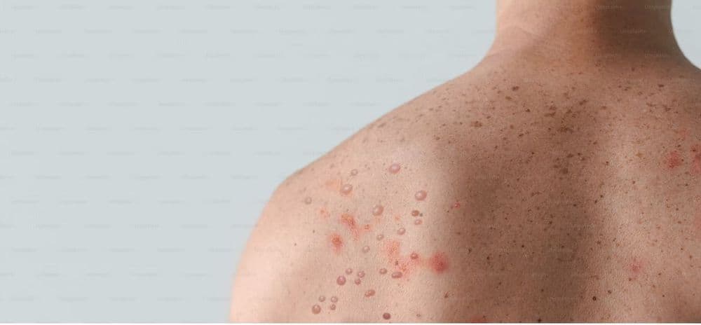 Le nombre de cas de rougeole explose en Europe, avertit l’OMS