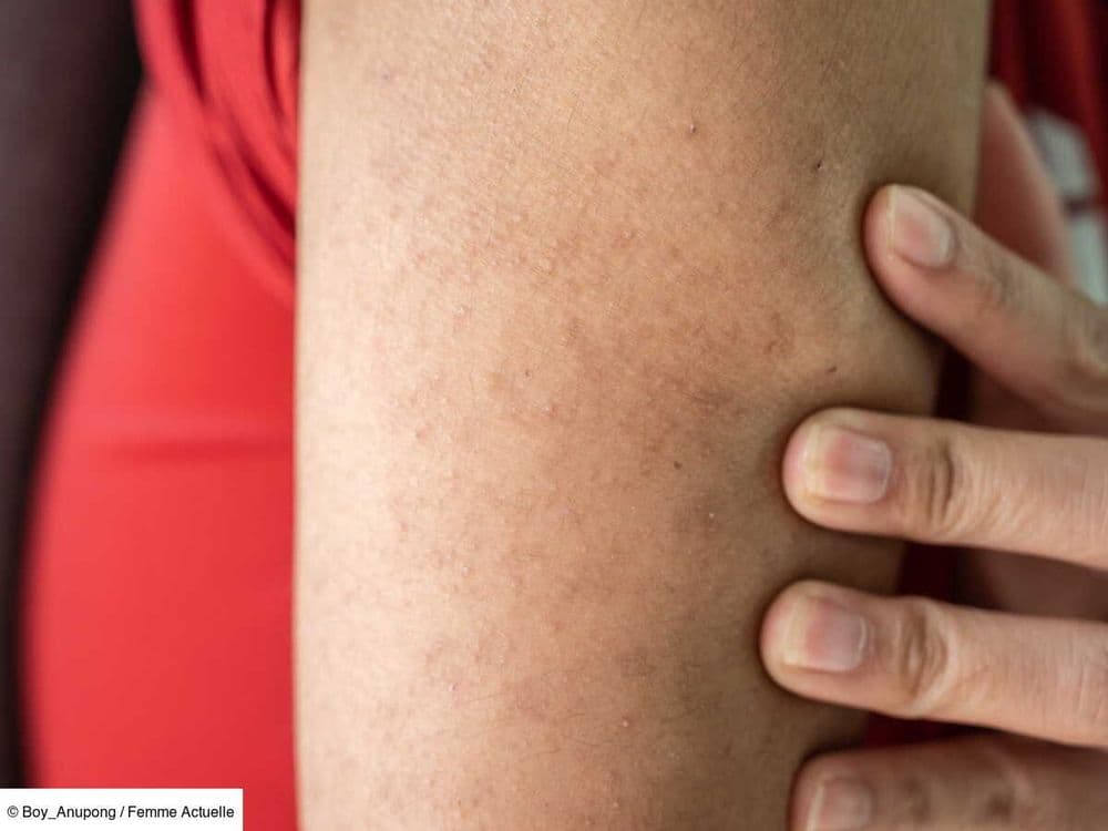 "Peau de fraise” : 3 astuces de dermatologue pour venir à bout de la kératose pilaire