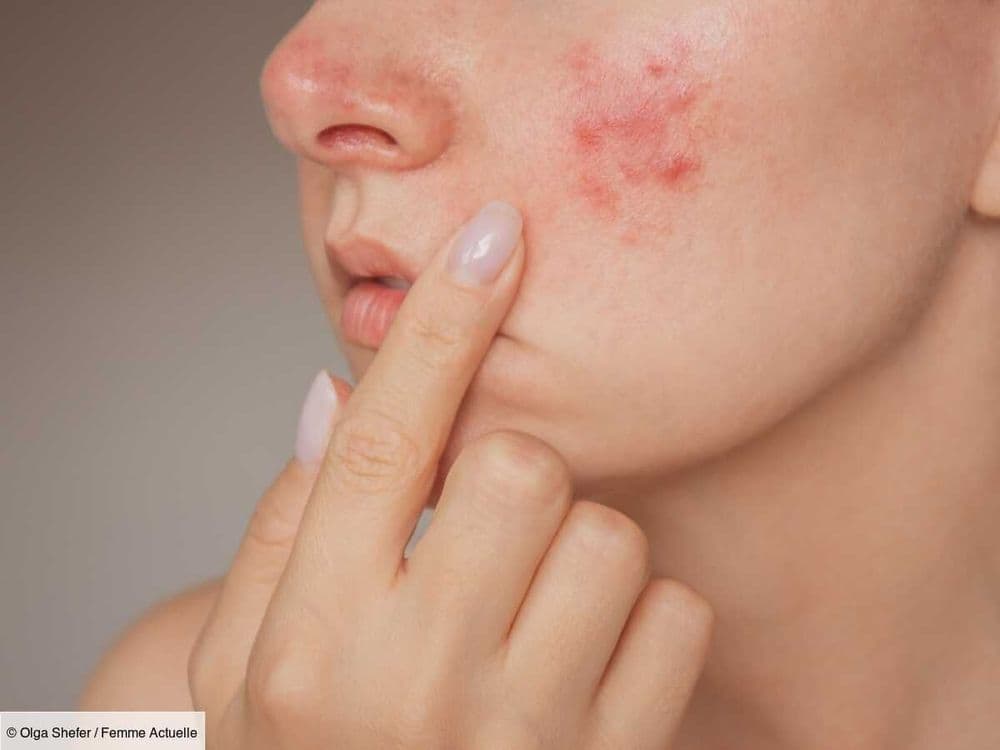 "Il est possible de contrôler votre rosacée" : une dermatologue dévoile ses conseils pour réduire les rougeurs sur la peau