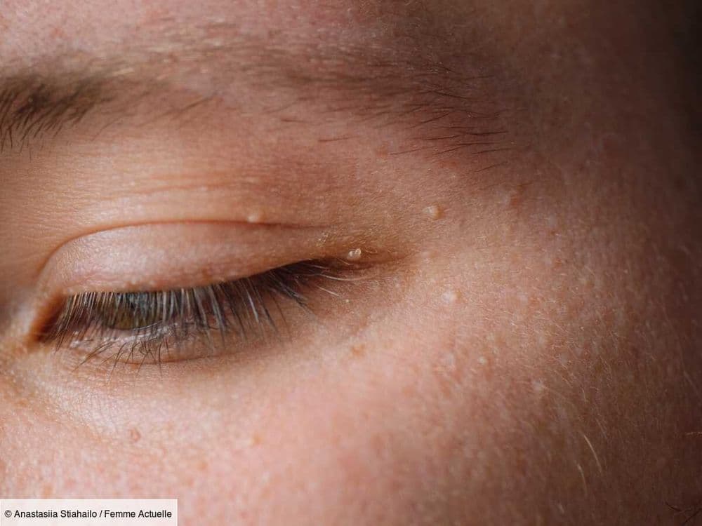 Comment se débarrasser des grains de milium ? Une dermatologue conseille 2 ingrédients à appliquer