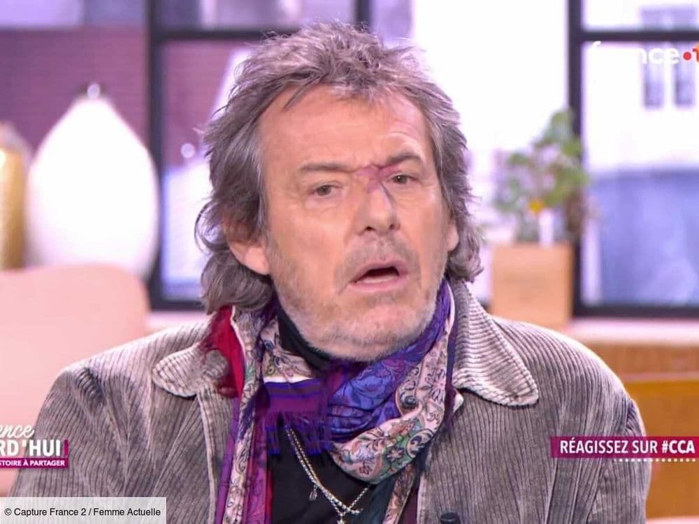 "Le pire, c’est à l’âge de 14 ans…" : la terrible raison pour laquelle Jean-Luc Reichmann n’a pas fait retirer son angiome malgré les moqueries