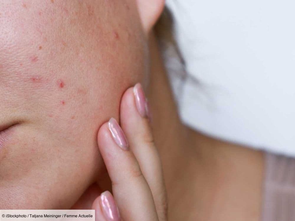 Vous avez des boutons sur le visage à cause de la chaleur ? Une dermatologue explique les raisons et comment les atténuer