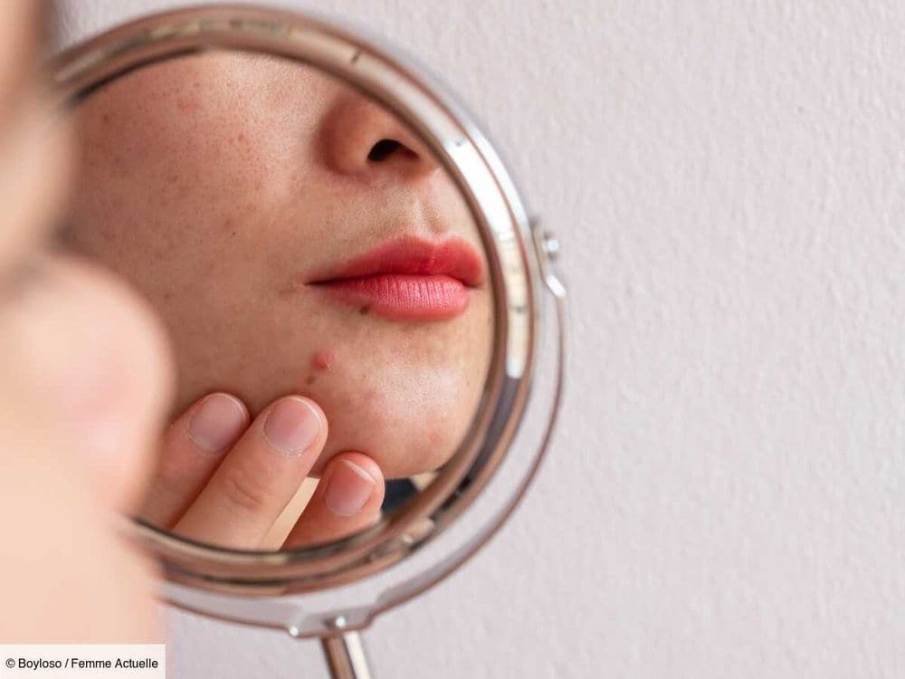 Faut-il percer un bouton sur le visage ? Une dermatologue répond