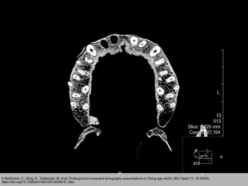 Caries, sinusite, arthrose…Les Vikings étaient curieusement victimes de nombreuses maladies