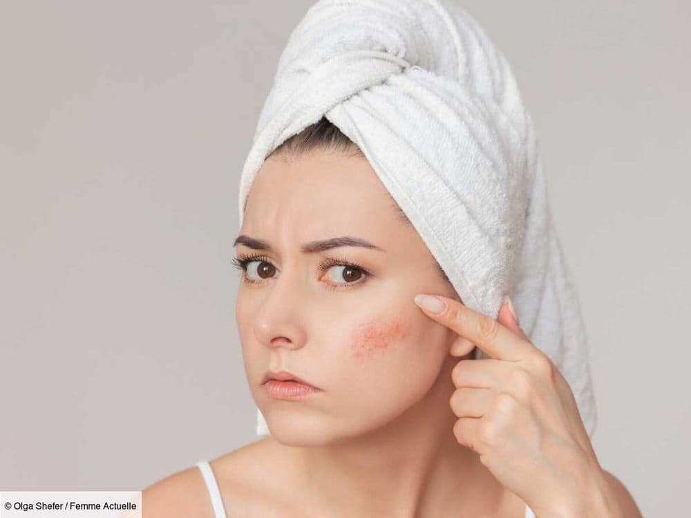 Rosacée : 7 conseils simples d’une dermatologue pour réduire les rougeurs sur la peau