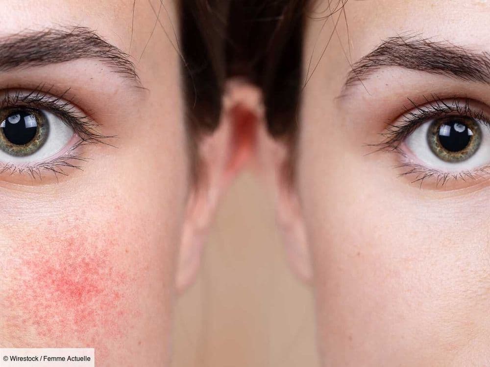 Acné, psoriasis, rosacée : ces 7 aliments accentuent ces problèmes de peau, selon une dermatologue