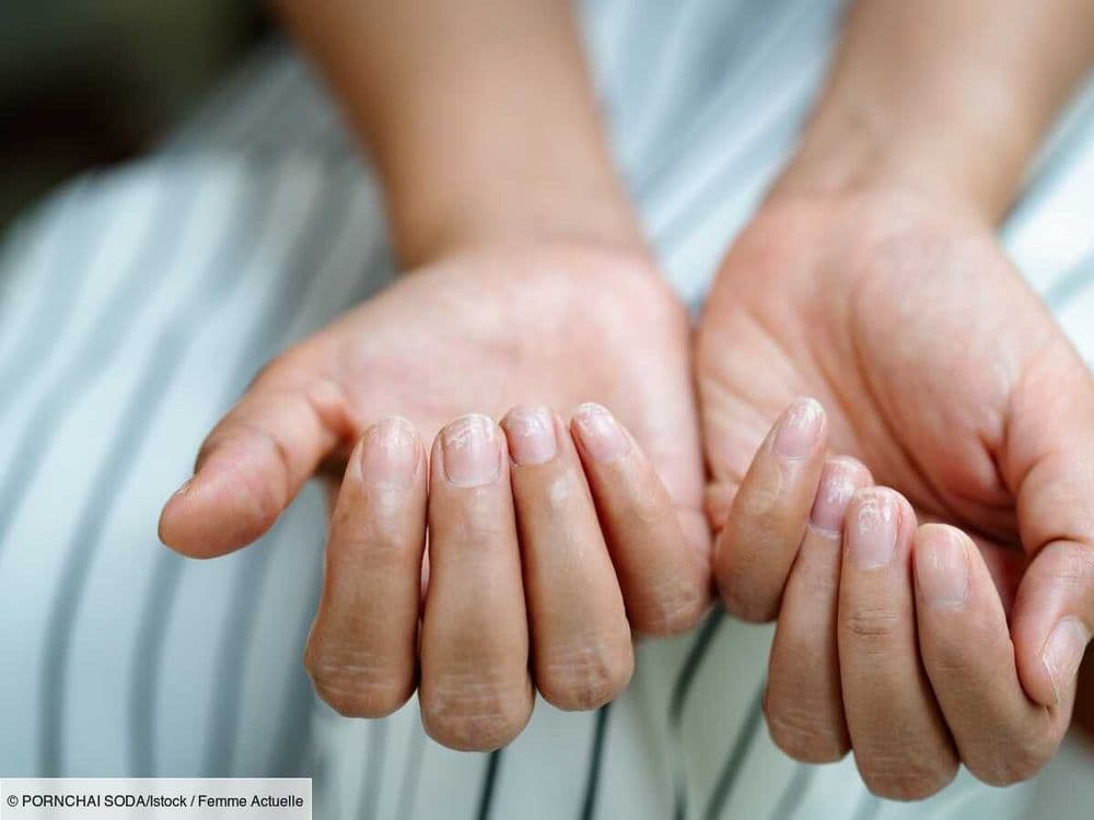 Vos ongles sont mous et cassants ? Suivez les conseils de ces dermatologues