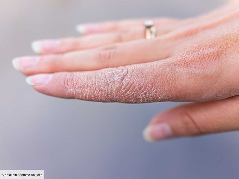 Mains très sèches et craquelées : voici les ingrédients les plus hydratants pour la peau selon un dermatologue