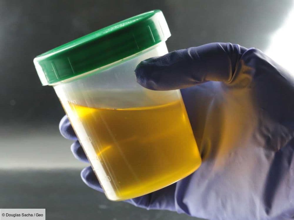 Notre urine, nouvelle alliée de la médecine pour réparer les os et les dents