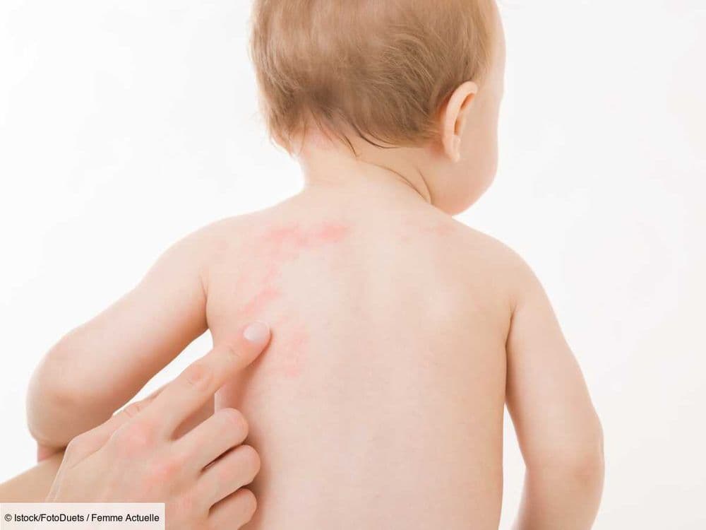 Roséole chez le bébé : comment reconnaître les boutons associés à cette maladie virale ?