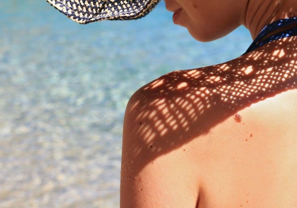 Comment surveiller un grain de beauté ?