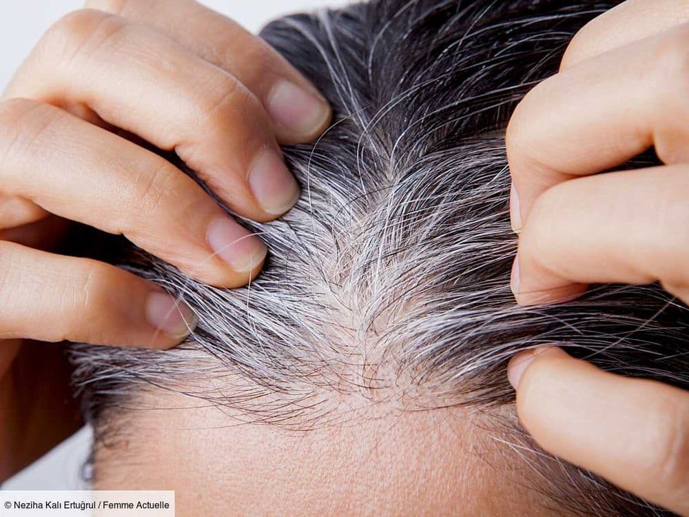 Cheveux blancs : voici les vitamines qui permettent de ralentir leur apparition selon un dermatologue