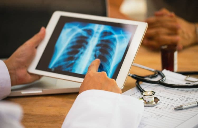 Cancer du poumon : pourquoi les femmes et les non-fumeurs sont de plus en plus à risque