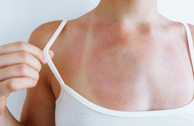 Après la tendance “anti-crème solaire”, la trend “Burn lines” est celle qui inquiète vivement les dermatologues