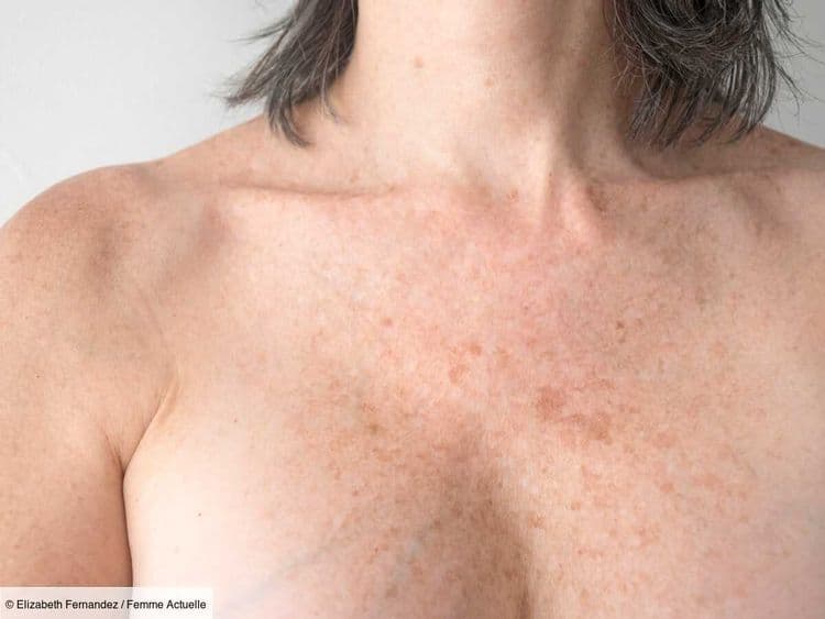 Taches solaires ou hyperpigmentation : une dermatologue explique comment différencier les taches brunes (et comment les atténuer)