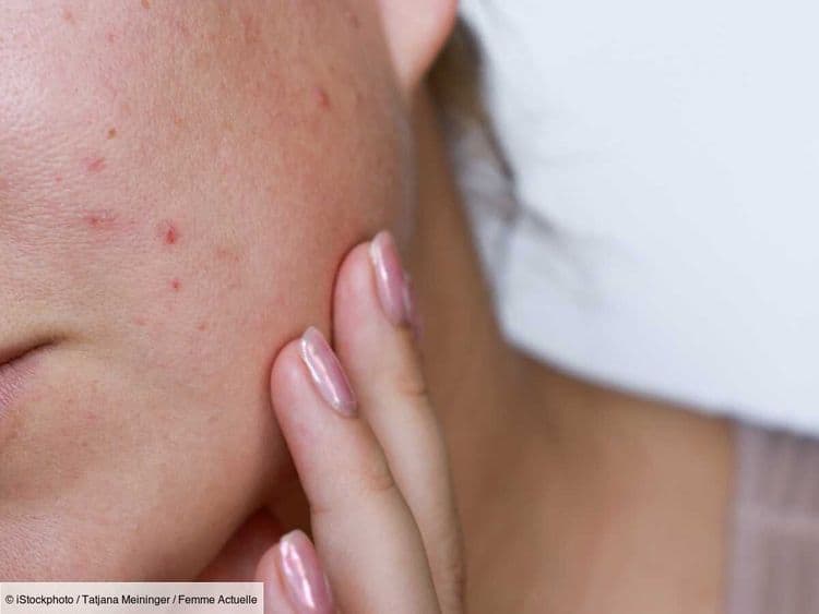 Vous avez des boutons sur le visage à cause de la chaleur ? Une dermatologue explique les raisons et comment les atténuer