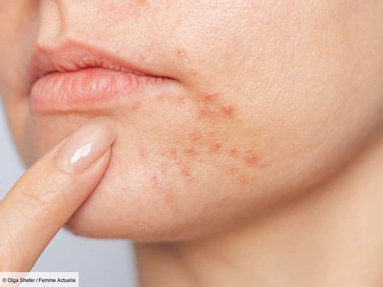 Dermatite périorale : voici comment prendre soin de se peau en cas de plaques autour de la bouche, selon une dermatologue