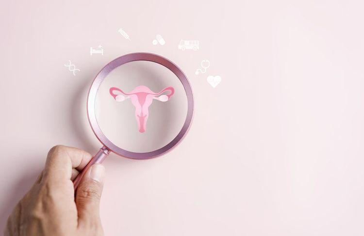 Une endométriose sévère expose à 10 fois plus de risque de contracter un cancer de l’ovaire