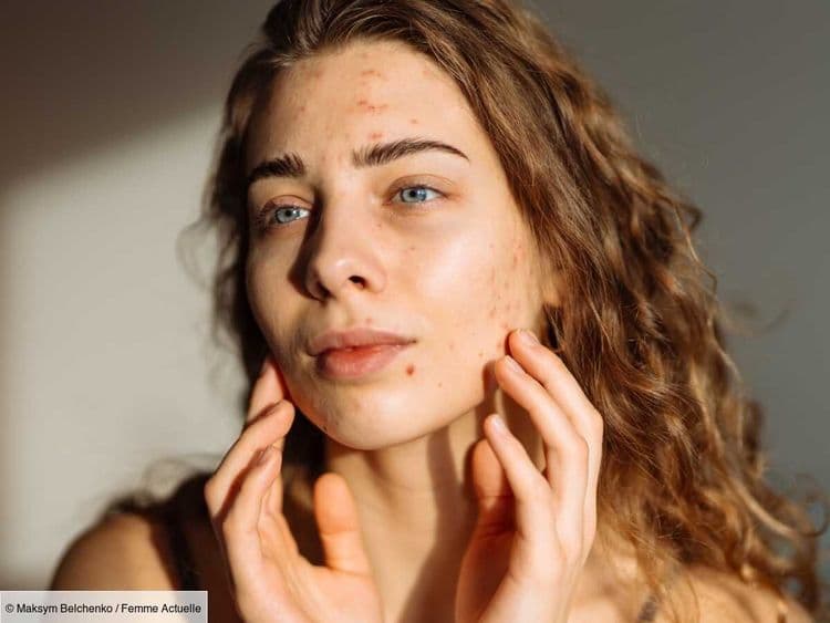 "À cause de l'acné, j'ai peur de dormir chez des amis, je ne supporte plus mon reflet" - le témoignage d’Océane, 22 ans