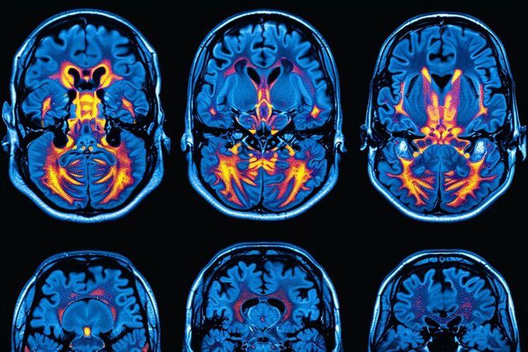 Espoir dans la lutte contre Alzheimer : une protéine protectrice du cerveau, clé d’un nouveau traitement ?