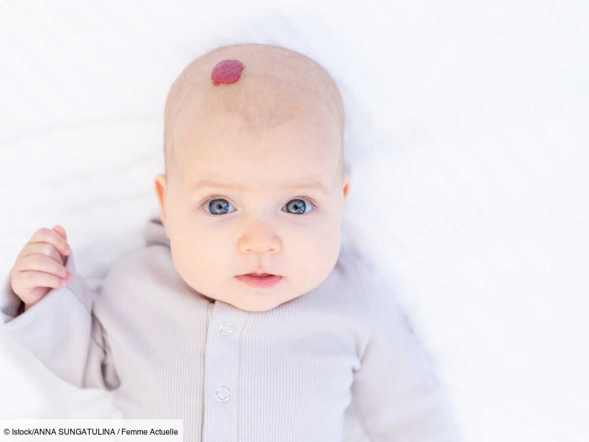 Hémangiome du bébé : causes, signes et traitements