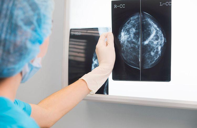 Dépistage du cancer du sein : moins de 50 % des femmes de 50 à 74 ans y ont recours