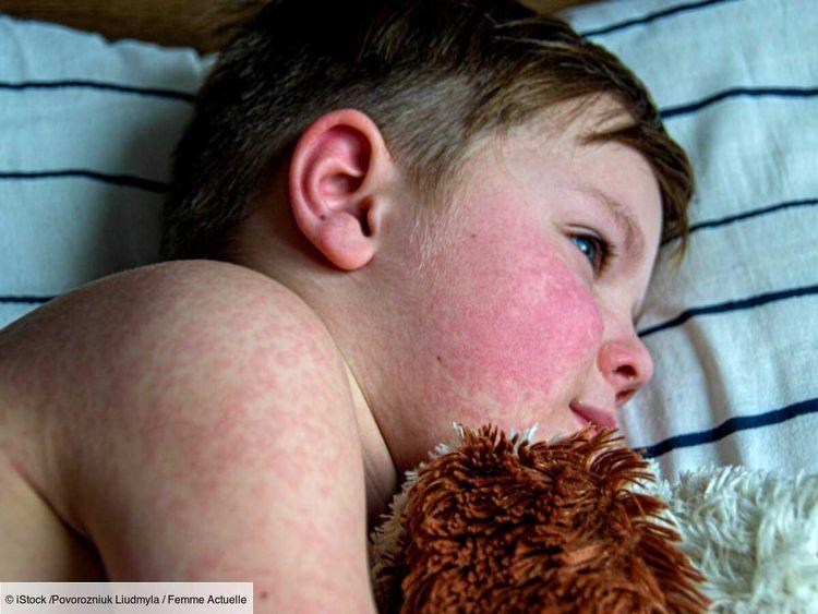 Épidémie de parvovirus B19 en France : quels sont les symptômes chez l’enfant ?